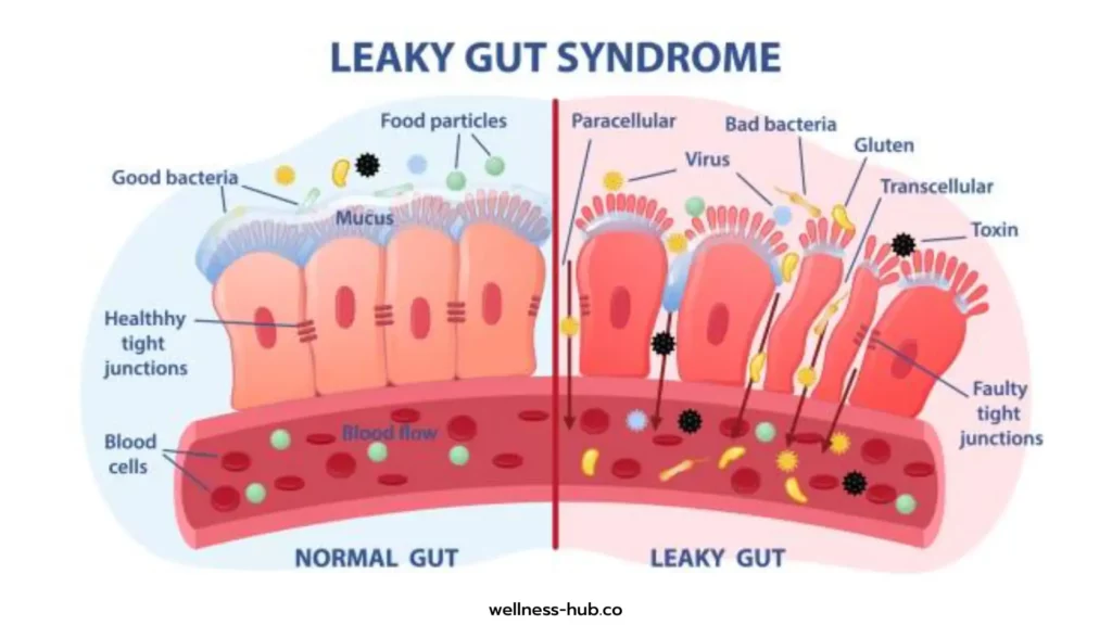 ลำไส้รั่ว Leaky Gut | อาการ-สาเหตุ-รักษา-ป้องกัน