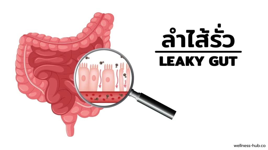 ลำไส้รั่ว Leaky Gut